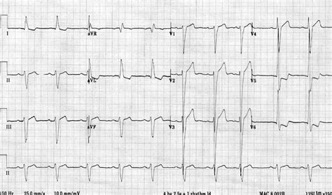 ekg showing left ventricular hypertrophy.